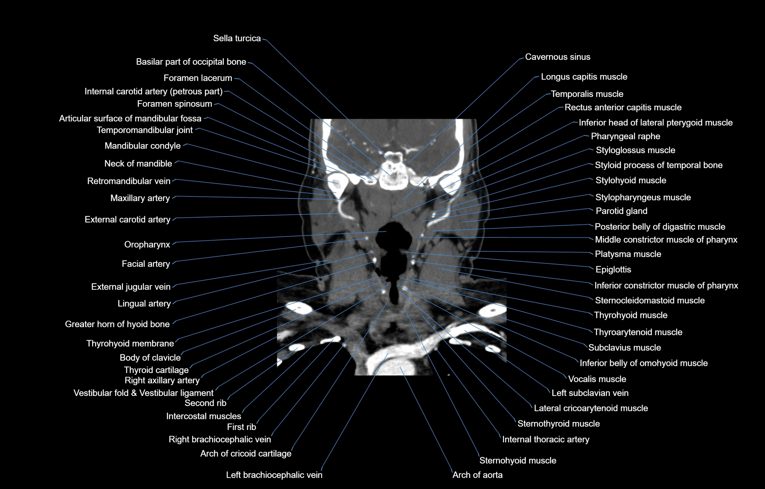 CT Neck coronal  cross sectional anatomy labelled 3D  radiology  image-00033.webp